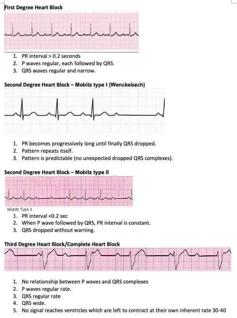 ZHeart11768530's tweet image. 🔴Heart Blocks/AV Block⤵️

 #MedStudentTwitter #Management #FOAMcc #Guidelines #CVD #cardiology #diagnosis #ECG #EKG #interpretation #MedEd #MedTwitter #QRS #diabetes #CardioEd #Cardiology #pharmacology #FOAMed #Cardiology #CardioEd #CardioTwitter #openaccess #august2023