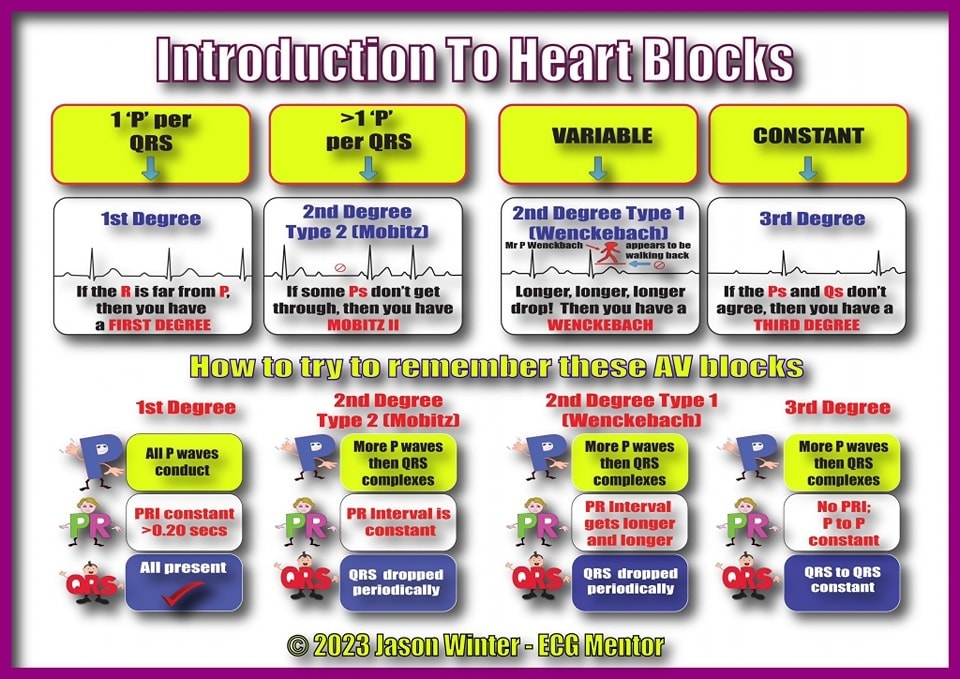 ZHeart11768530's tweet image. 🔴Heart Blocks/AV Block⤵️

 #MedStudentTwitter #Management #FOAMcc #Guidelines #CVD #cardiology #diagnosis #ECG #EKG #interpretation #MedEd #MedTwitter #QRS #diabetes #CardioEd #Cardiology #pharmacology #FOAMed #Cardiology #CardioEd #CardioTwitter #openaccess #august2023