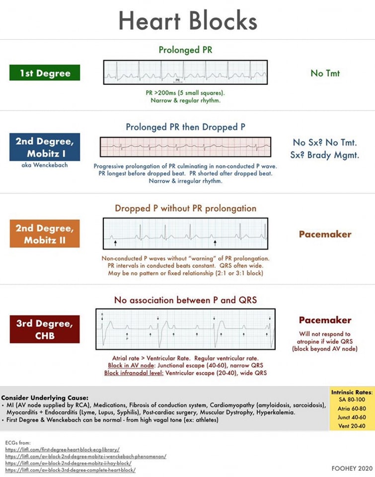 ZHeart11768530's tweet image. 🔴Heart Blocks/AV Block⤵️

 #MedStudentTwitter #Management #FOAMcc #Guidelines #CVD #cardiology #diagnosis #ECG #EKG #interpretation #MedEd #MedTwitter #QRS #diabetes #CardioEd #Cardiology #pharmacology #FOAMed #Cardiology #CardioEd #CardioTwitter #openaccess #august2023