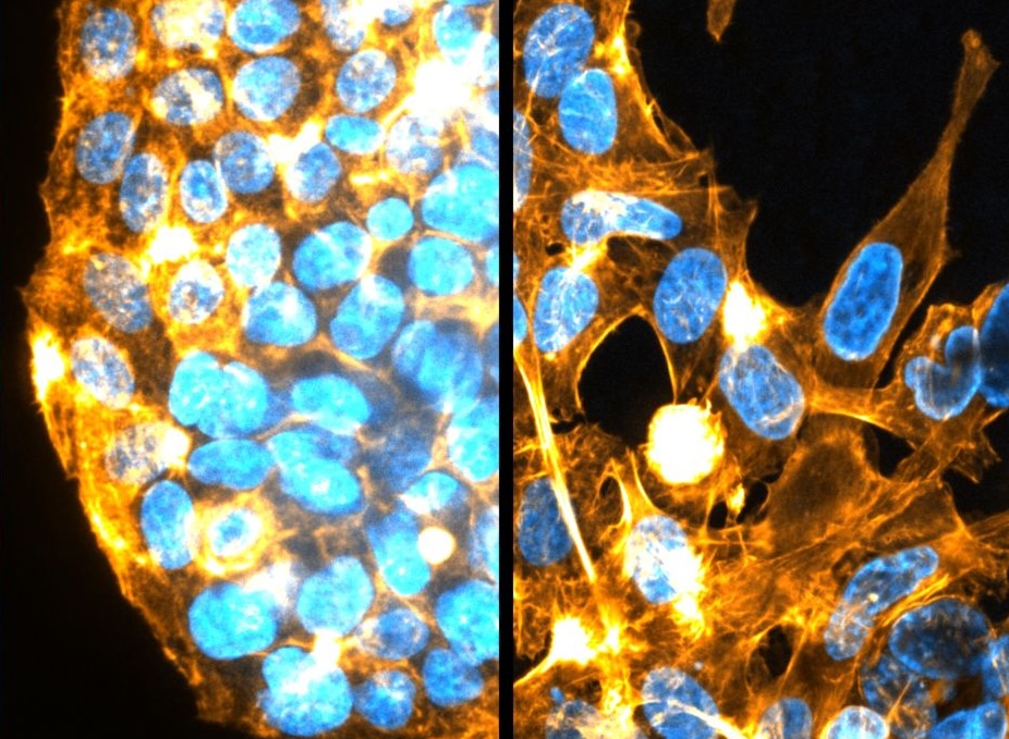 Yale School of Medicine (@yalemed) on Twitter photo In new research published in <a href="/CR_AACR/">Cancer Research</a>, YSM researchers at <a href="/YaleCancer/">Yale Cancer Center</a> find physical pressure – like what cells experience inside solid #liver #tumors – escalates #cancer cell aggression. medicine.yale.edu/news-article/n… In new research published in <a href="/CR_AACR/">Cancer Research</a>, YSM researchers at <a href="/YaleCancer/">Yale Cancer Center</a> find physical pressure – like what cells experience inside solid #liver #tumors – escalates #cancer cell aggression. medicine.yale.edu/news-article/n…