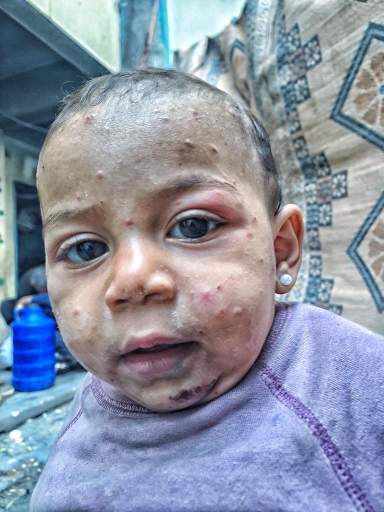 Our hearts ache for Tasneem. The skin disease has returned, mercilessly eating away at her little body, depriving her of even a few moments of rest. Tasneem cries bitterly, her tears heartbreaking, and I am overwhelmed with worry and fear for her. The harsh weather is making her