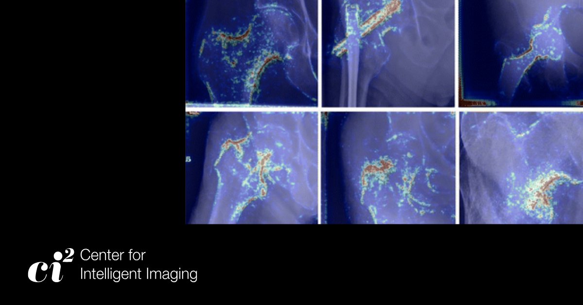 UCSF Center for Intelligent Imaging (@ucsf_ci2) on Twitter photo The <a href="/UCSF_Ci2/">UCSF Center for Intelligent Imaging</a> Hip Fracture Detection Program uses models aided by #MachineLearning to improve physician accuracy in detection & classification. Visit intelligentimaging.ucsf.edu/news/clinical-… to read about the program & related research. #OsteoporosisAwarenessMonth The <a href="/UCSF_Ci2/">UCSF Center for Intelligent Imaging</a> Hip Fracture Detection Program uses models aided by #MachineLearning to improve physician accuracy in detection & classification. Visit intelligentimaging.ucsf.edu/news/clinical-… to read about the program & related research. #OsteoporosisAwarenessMonth