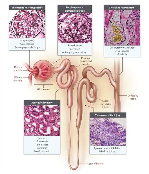 JasmineNephro's tweet photo. 🫘👉AKI in patients with Cancer

https://t.co/trV7KJaXVU

@NEJM https://t.co/x9o9jvuM5I