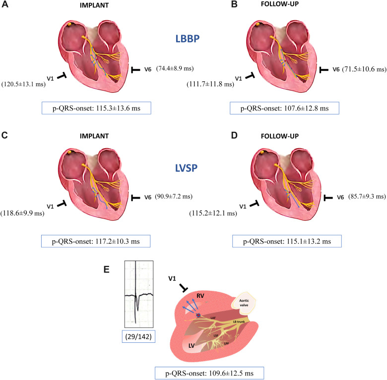 Heart Rhythm O2 (@hrs_o2journal) on Twitter photo Evaluating electrical stability in left bundle branch area pacing for bradycardia patients at follow-up, by <a href="/SemBriongos/">Sem Briongos Figuero</a> and colleagues #EPeeps
heartrhythmopen.com/article/S2666-… Evaluating electrical stability in left bundle branch area pacing for bradycardia patients at follow-up, by <a href="/SemBriongos/">Sem Briongos Figuero</a> and colleagues #EPeeps
heartrhythmopen.com/article/S2666-…