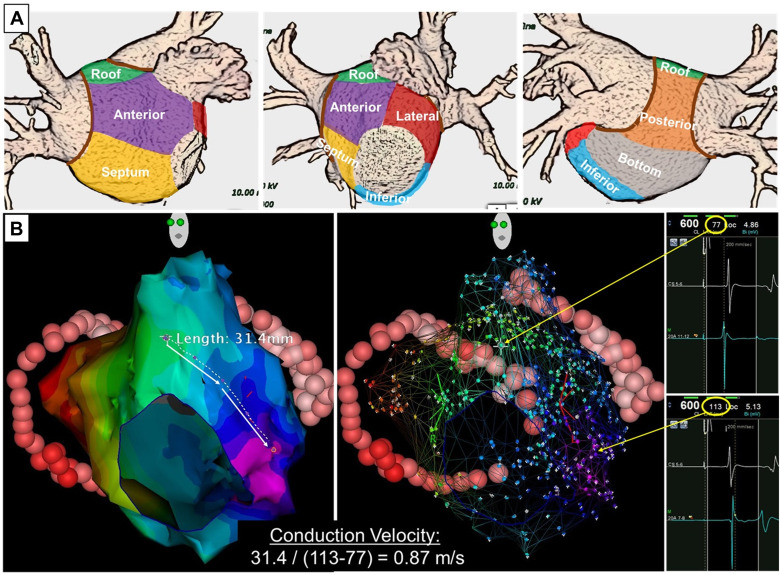 Conduction characteristics in the left atrium of patients with perimitral atrial tachycardia post–pulmonary vein isolation
#EPeeps
heartrhythmopen.com/article/S2666-…