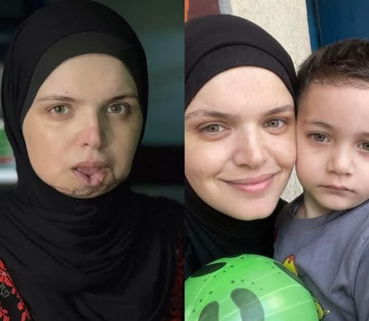 🚨Injured journalist Dohaa Al-Sayyifi, who lost her three children, her lower jaw, and suffered a severe hand injury, wrote:

“I am the voice that could not be silenced, despite the wounds.”

I am a Palestinian from Gaza — a witness to pain, a survivor of a massacre that stole my