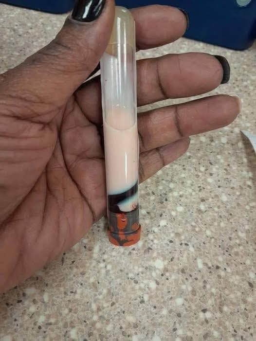 Ceci est un échantillon du sang qui a été prélevé aujourd'hui sur un patient qui s'est présenté pour de fortes douleurs abdominales et des douleurs accompagnées d'engourdissements dans les jambes et les pieds. 

Quand il est sorti, il était rouge, mais une fois assis, il a