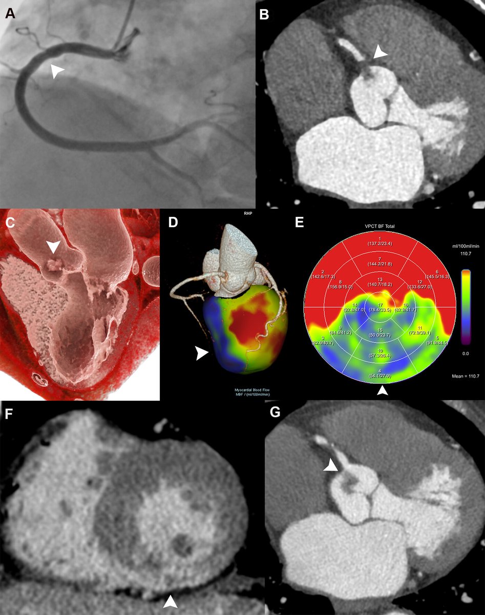 Take a look at a case of floating aortic thrombus and acute myocardial infarction as seen at angiography, CT, 3D volume rendering, and a CT myocardial perfusion map. bit.ly/44O4qSH