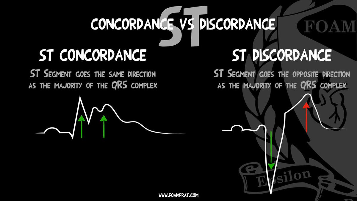ST Concordance VS ST Discordance 
Concordance &amp; Discordance is used in the evaluation of a number of ECG abnormalities such as identification of VT vs SVT and identification of OMI in patients with a LBBB or ventricular paced rhythm using the Smith-Modified Sgarbossa Criteria