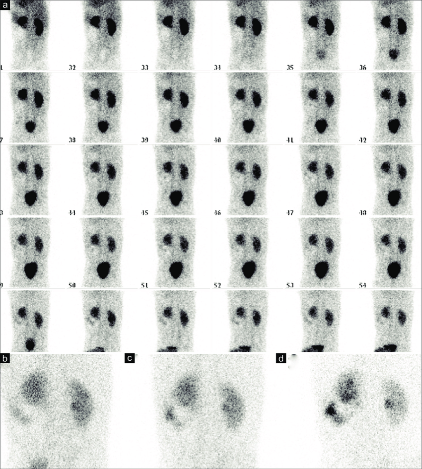 🧪 DTPA Renal Scan – When to Use It?
Tc-99m DTPA is a dynamic nuclear scan to assess 💧perfusion, 🚰drainage &amp; 📉GFR.
✨ Indications:
🩺 Renal artery stenosis – assess perfusion

🚽 Obstructive uropathy – diuretic renogram

📊 Split renal function – DRF estimation

🔬 GFR