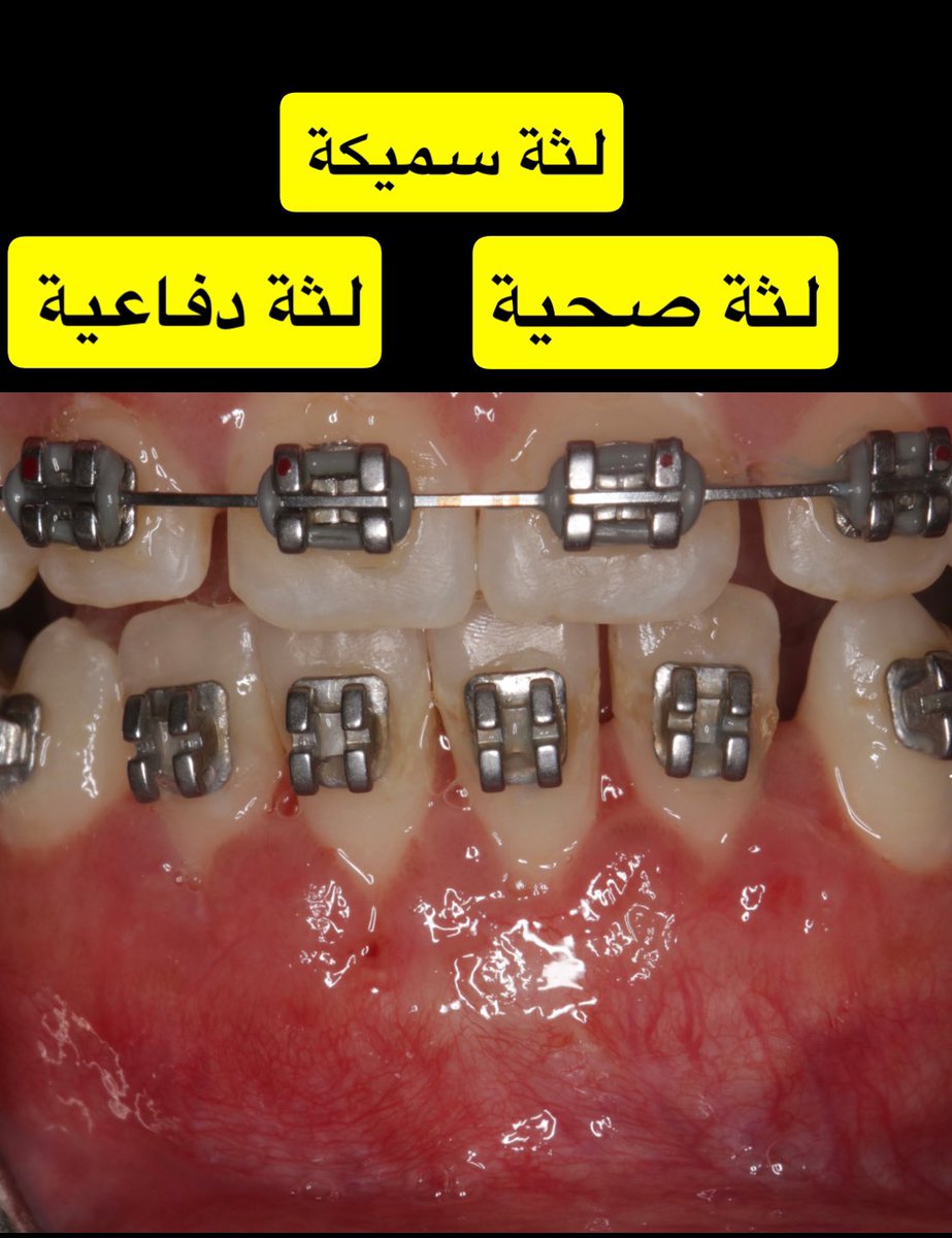 تسميك أو زراعة اللثة له دور أساسي في الحفاظ على الأسنان، سواء قبل أو خلال التقويم، وفي حالات انحسار اللثة أو التحضير لزراعة الأسنان.

الصورة توضح لثة رقيقة وانحسار في اللثة وبروز في الأسنان.
النتيجة بعد الإجراء: لثة سميكة، لثة دفاعية، لثة صحية.
#لثة #زراعة_أسنان <a href="/Dr_Hussam_Perio/">Dr. Hussam Alqahtani</a>