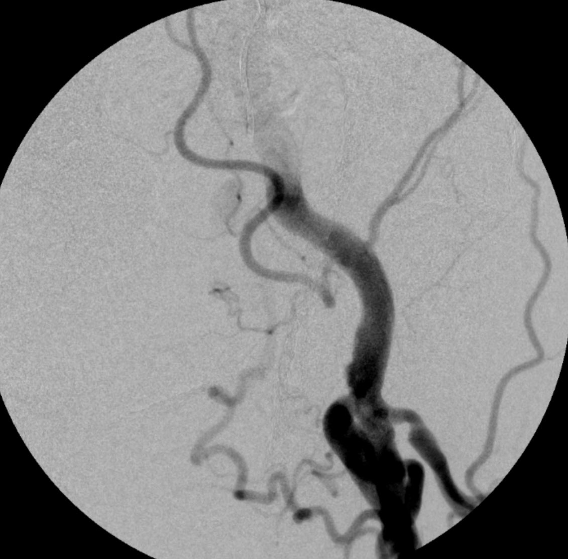 DonGarbettMD's tweet image. #PAE Advanced Prostate Embolization. 70 ish yo with IPSS26 with PAD and left internal iliac artery occlusion. Profunda to hypo to prostate artery via collaterals. Keeping it fun and great for patients. @ASAHIINTECCMEDI @terumoisuk
@IRcenters @SIRRFS @SIRspecialists…