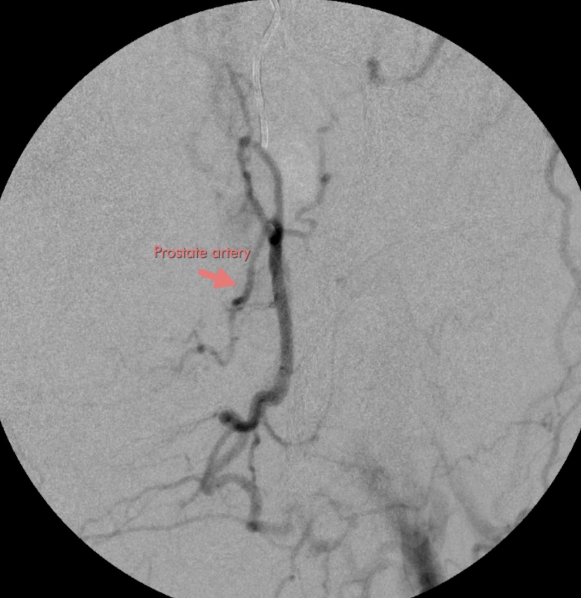 DonGarbettMD's tweet image. #PAE Advanced Prostate Embolization. 70 ish yo with IPSS26 with PAD and left internal iliac artery occlusion. Profunda to hypo to prostate artery via collaterals. Keeping it fun and great for patients. @ASAHIINTECCMEDI @terumoisuk
@IRcenters @SIRRFS @SIRspecialists…