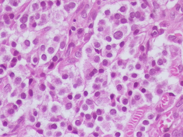 1/ Dear #PathTwitter #PathX Oracle #Pathpulm #Thoracicpath 
What is your favored diagnoses on this young patient , 2 cm mass obstructing right bronchus .
transbronquial bx
Differential diagnosis and IHC suggested .
If you are living in a #limmitedresourcecountries  then you know