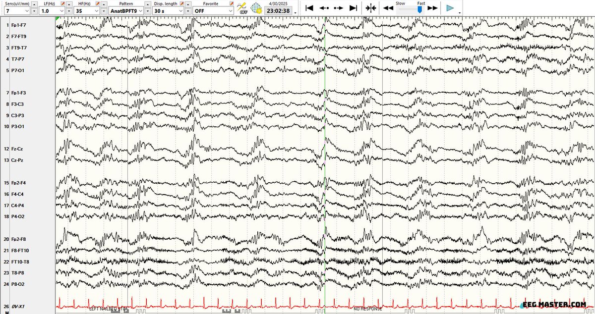 60 yo female with altered mental status. Her left nail-bed was pressed at the beginning of EEG epoch shown below. How would you best describe her EEG findings? Click on this link to see the options, submit your answer and view the explanation.  eegmaster.com/eegmaster/quiz…