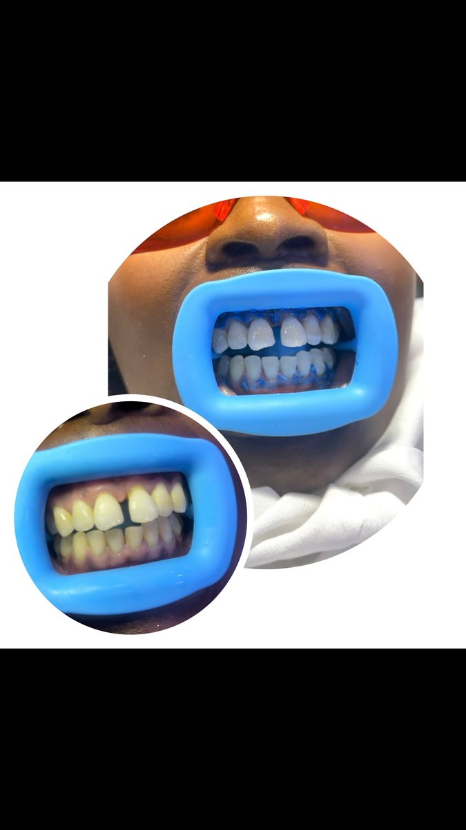 Stineaesthetics's tweet photo. Before and after our teeth whitening session https://t.co/EM8RVNf1d6