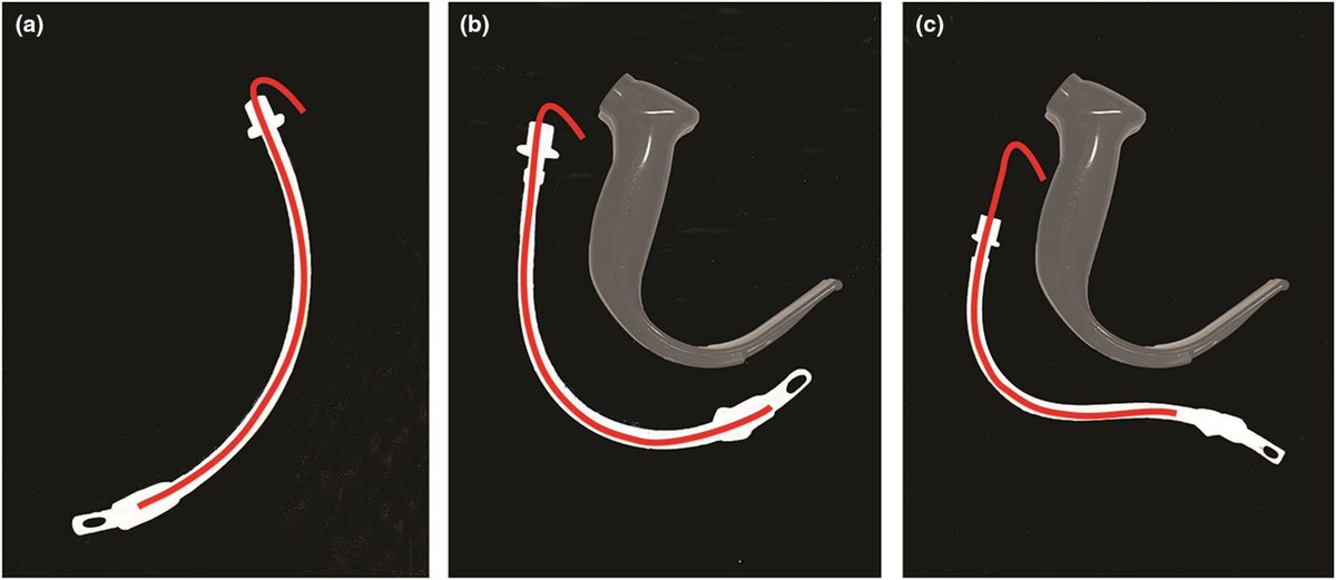 When using a hyperangulated videolaryngoscope have you tried "reverse loading" a tracheal tube on to a preformed stylet?

The stylet &amp; tracheal tube are shaped forcibly in the opposite direction to the normal curvature and to match the shape of the blade.

#anaesthesia