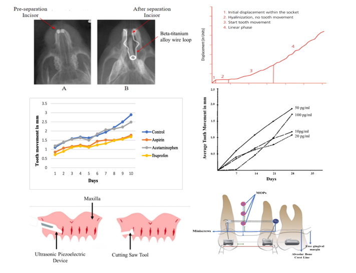 Effective techniques and emerging alternatives in orthodontic tooth movement: A systematic review sciencedirect.com/science/articl……… #Orthodontic tooth movement #Malocclusion #Tooth alignment #Bone remodeling #Surgical method #Drug-induced tooth movement #MedTwitter #scicomm #MedEd