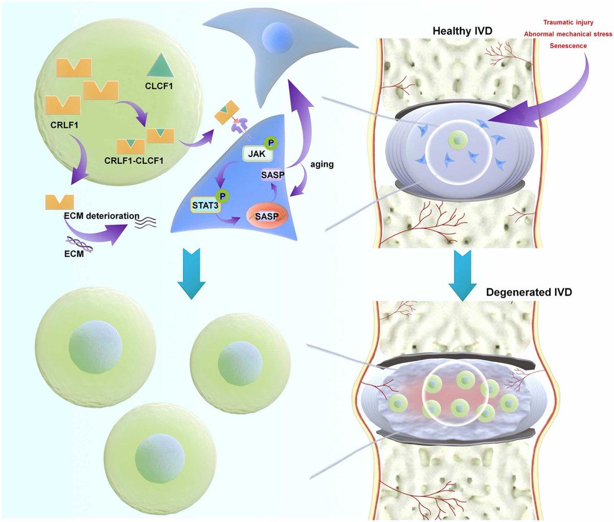 New this month in #OAC for #BasicScience Learn about how the CRLF1/CLCF1 heterodimer is involved in IVDD via exacerbation of ECM degradation and nucleus pulposus cell senescence🧪 sciencedirect.com/science/articl…
via <a href="/OACJournal/">Osteoarthritis and Cartilage Journals</a>