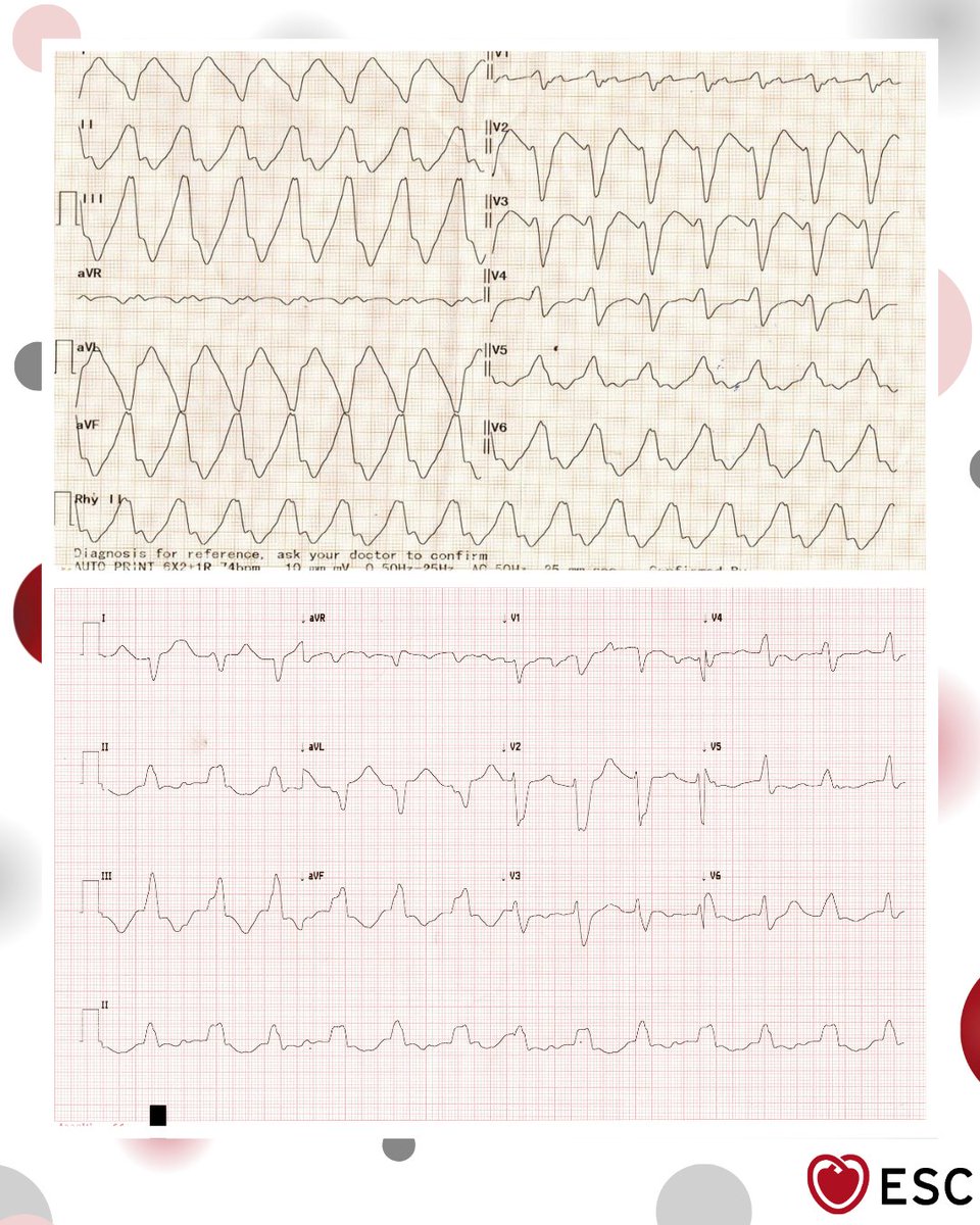 escardio's tweet photo. #ImageoftheWeek by Mayank Yadav, Dr. Abhinav Shrivastava, and Dr. Divya Parepalli from Fortis Hospital in Kangra, India.
A young male presented with complaints of dyspnea and decreased urine output. What is the diagnosis? https://t.co/wr2mLiLR6G
#cardioed #ESCYoung https://t.co/22rJrZrIC1