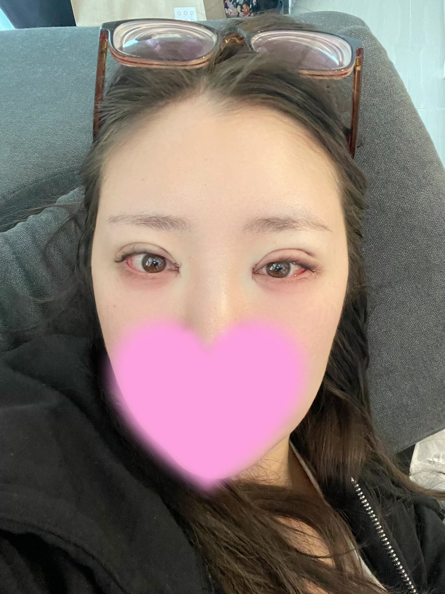 terrorist_chan's tweet photo. 取り急ぎ @hanips_jp での二重の再手術全て終わりました！今結構腫れてて辛いけど、絶対腫れ引いたら可愛い目になる予感🧏🏻‍♀️💞 https://t.co/AGtpcB9DMv