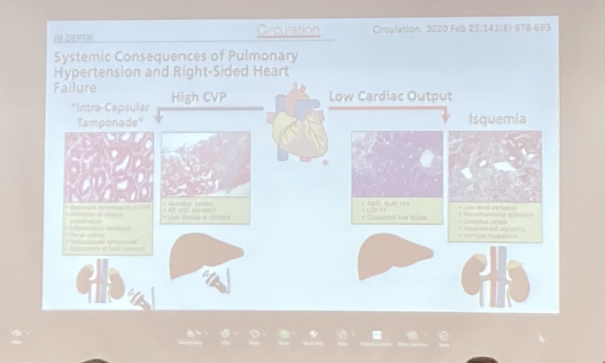 korbinhaycockmd (@khaycock2) on Twitter photo <a href="/ArgaizR/">Eduardo R Argaiz</a> one of the all time nephrologist/POCUS greats (along with <a href="/NephroP/">NephroPOCUS</a> ) talking about the kidney venous stasis index. #HR25
<a href="/ThinkingCC/">Philippe Rola</a> <a href="/KiranRikhraj/">Kiran Rikhraj</a> <a href="/ross_prager/">Ross Prager</a> <a href="/ArgaizR/">Eduardo R Argaiz</a> one of the all time nephrologist/POCUS greats (along with <a href="/NephroP/">NephroPOCUS</a> ) talking about the kidney venous stasis index. #HR25
<a href="/ThinkingCC/">Philippe Rola</a> <a href="/KiranRikhraj/">Kiran Rikhraj</a> <a href="/ross_prager/">Ross Prager</a>