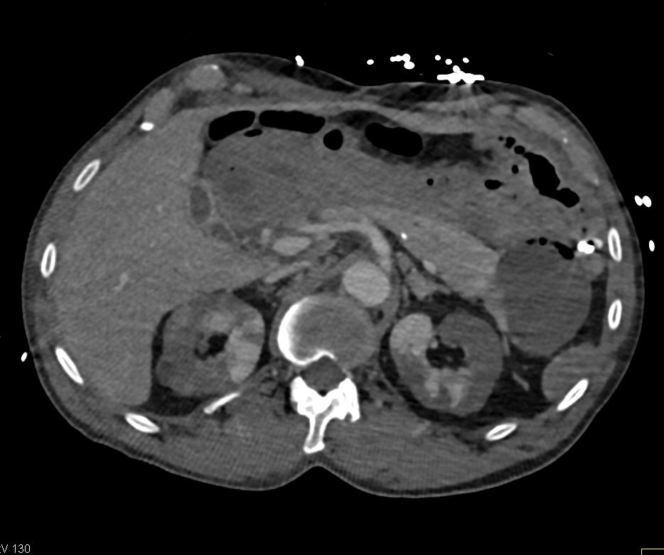 Poor Renal Perfusion in Hypotensive Patient