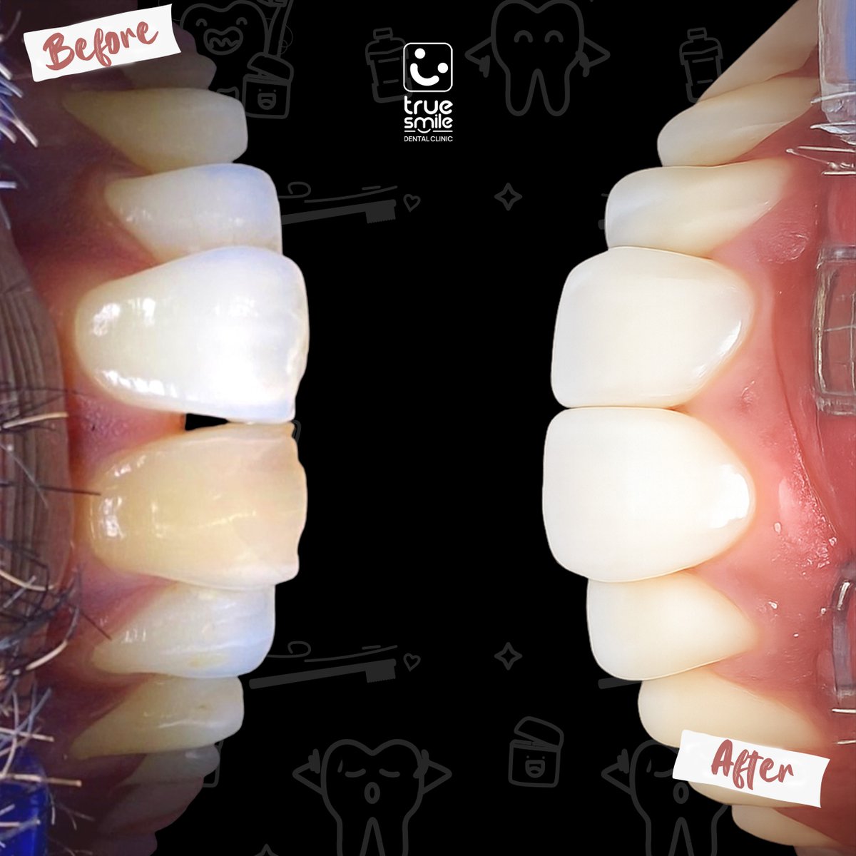 True Smile Dental Clinic (@clinictrue) on Twitter photo โจ ๐๐ฆ๐ข๐ฅ๐ ๐๐จ๐ซ๐ซ๐๐๐ญ๐ข๐จ๐ง: ๐๐ง๐ ๐ญ๐ก๐ ๐๐๐ฌ๐ญ ๐ข๐ฌ ๐๐ข๐ฌ๐ญ๐จ๐ซ๐ฒ!
A small change in your smile can make a big difference in your confidence! Whether itโs aligning teeth, closing gaps, or refining your bite, our advanced smile designing treatments can transform โจ ๐๐ฆ๐ข๐ฅ๐ ๐๐จ๐ซ๐ซ๐๐๐ญ๐ข๐จ๐ง: ๐๐ง๐ ๐ญ๐ก๐ ๐๐๐ฌ๐ญ ๐ข๐ฌ ๐๐ข๐ฌ๐ญ๐จ๐ซ๐ฒ!
A small change in your smile can make a big difference in your confidence! Whether itโs aligning teeth, closing gaps, or refining your bite, our advanced smile designing treatments can transform