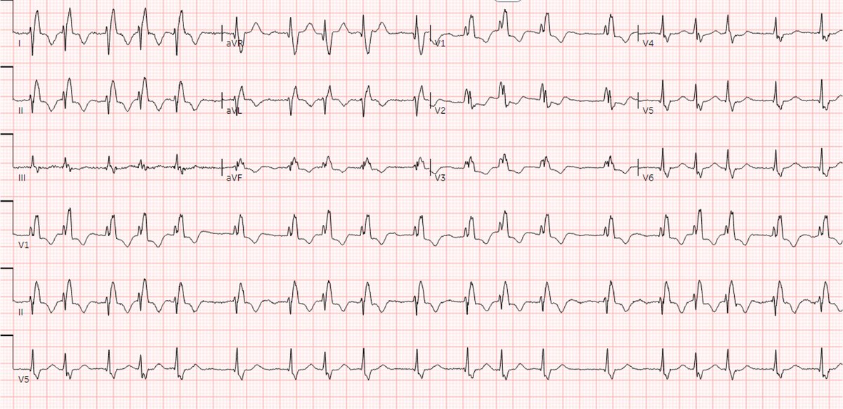 UC San Diego Cardiology Fellows (@ucsdcardfellows) on Twitter photo New #UCSDCardiologyCases! 🧐
Middle aged F w/ metastatic endometrial cancer, HFrecEF, pAF on apixaban, presents w/ worsening SOB & weight gain. Exam: tachy, JVD, crackles, edema. ECG: Below. What's brewing? #CardioTwitter #CardioOnc #MedTwitter <a href="/UCSDCardiology/">UC San Diego Cardiology</a> New #UCSDCardiologyCases! 🧐
Middle aged F w/ metastatic endometrial cancer, HFrecEF, pAF on apixaban, presents w/ worsening SOB & weight gain. Exam: tachy, JVD, crackles, edema. ECG: Below. What's brewing? #CardioTwitter #CardioOnc #MedTwitter <a href="/UCSDCardiology/">UC San Diego Cardiology</a>