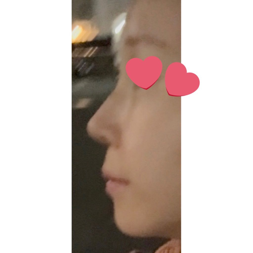 ____sbsmk's tweet photo. 鷲鼻がないことがもう幸せすぎて😭あと人中が短くなれば理想の横顔になれる気がするけどキリがないのでこの辺で様子みないとなあ https://t.co/XJ7QnecafU