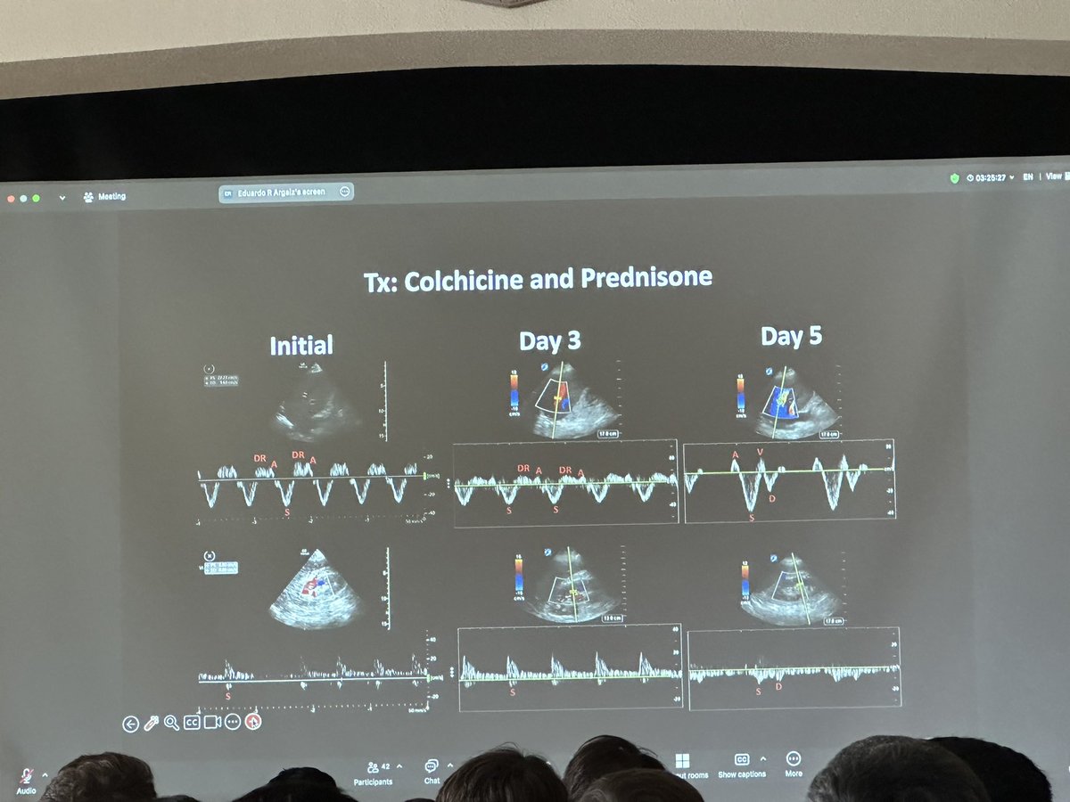 Matt Siuba (@msiuba) on Twitter photo Biggest #HR25 takeaway so far, by <a href="/ArgaizR/">Eduardo R Argaiz</a>
Systolic only interrupted renal flow may tell you something about pericardial disease (analogous to blunted Y descent) rather than typical causes of congestion! Biggest #HR25 takeaway so far, by <a href="/ArgaizR/">Eduardo R Argaiz</a>
Systolic only interrupted renal flow may tell you something about pericardial disease (analogous to blunted Y descent) rather than typical causes of congestion!