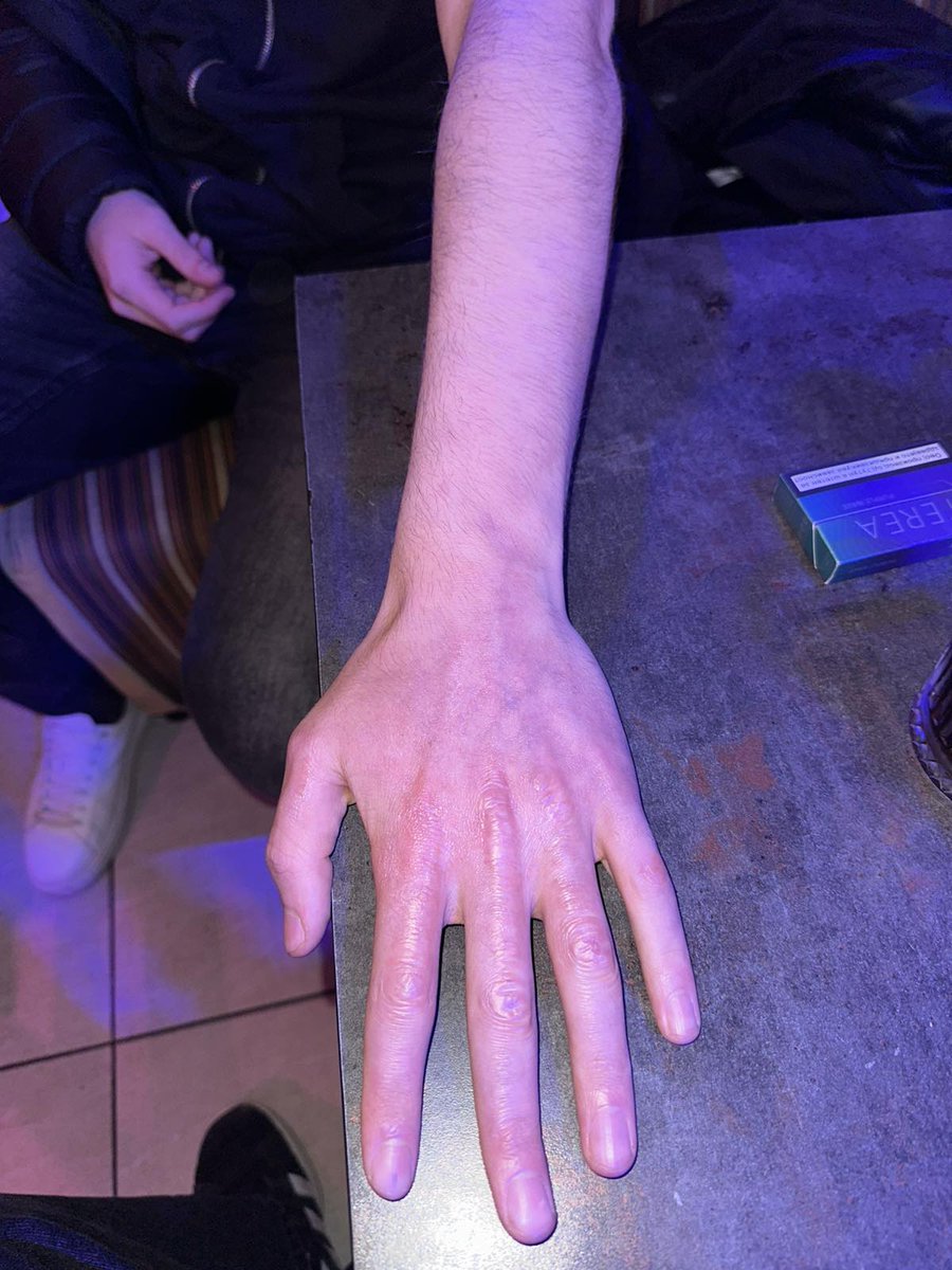 📢Ве молиме за #RT и помош

На повредените од пожарот во #Кочани, на кои им е, или ќе им биде трансплантирана кожа, итно им се потребни силиконски гел листови 🩹за регенерација на кожата и спречување на лузни.

Гел листовите е тешко да се пронајдат во Македонија и пациентите се