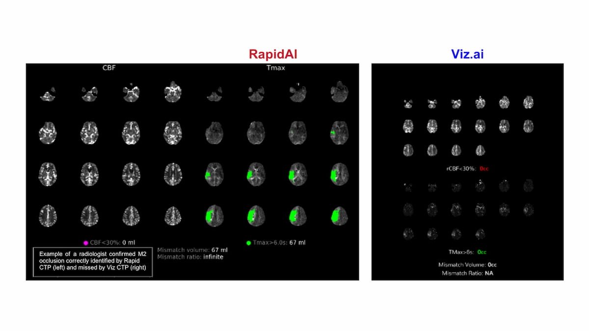 Diagnostic Imaging (@dx_imaging) on Twitter photo CT Perfusion Study Shows Enhanced Detection of Medium Vessel Occlusions with Emerging #AI Software
diagnosticimaging.com/view/ct-perfusā¦
<a href="/RadiologyACR/">American College of Radiology</a> <a href="/ARRS_Radiology/">ARRS</a> <a href="/SIRspecialists/">Society of Interventional Radiology</a> <a href="/Hopkins_Rad/">Johns Hopkins Radiology</a> <a href="/OSURadiology/">Ohio State Radiology</a> <a href="/YaleRadiology/">Yale Department of Radiology & Biomedical Imaging</a> <a href="/PennRadiology/">Penn Radiology</a> <a href="/ESOstroke/">European Stroke Org</a> <a href="/DukeRadiology/">Duke Radiology</a> <a href="/RapidAI/">RapidAI</a>
#radiology #RadRes CT Perfusion Study Shows Enhanced Detection of Medium Vessel Occlusions with Emerging #AI Software
diagnosticimaging.com/view/ct-perfusā¦
<a href="/RadiologyACR/">American College of Radiology</a> <a href="/ARRS_Radiology/">ARRS</a> <a href="/SIRspecialists/">Society of Interventional Radiology</a> <a href="/Hopkins_Rad/">Johns Hopkins Radiology</a> <a href="/OSURadiology/">Ohio State Radiology</a> <a href="/YaleRadiology/">Yale Department of Radiology & Biomedical Imaging</a> <a href="/PennRadiology/">Penn Radiology</a> <a href="/ESOstroke/">European Stroke Org</a> <a href="/DukeRadiology/">Duke Radiology</a> <a href="/RapidAI/">RapidAI</a>
#radiology #RadRes