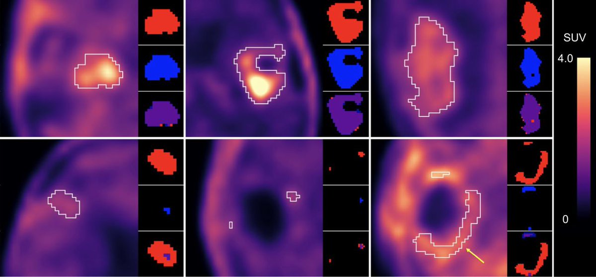 JNM (@journalofnucmed) on Twitter photo Can an automated ¹⁸F-FET PET segmentation network trained on brain tumor data generalize to an external cohort of patients with #glioblastoma? ow.ly/ZaZk50VEW1C
#NuclearMedicine #PETscan <a href="/ph_lohmann/">Philipp Lohmann</a> <a href="/galldiks/">Norbert Galldiks</a> <a href="/RobinGutsche/">Robin Gutsche</a> <a href="/NickWBucknell/">Nicholas Bucknell</a> Can an automated ¹⁸F-FET PET segmentation network trained on brain tumor data generalize to an external cohort of patients with #glioblastoma? ow.ly/ZaZk50VEW1C
#NuclearMedicine #PETscan <a href="/ph_lohmann/">Philipp Lohmann</a> <a href="/galldiks/">Norbert Galldiks</a> <a href="/RobinGutsche/">Robin Gutsche</a> <a href="/NickWBucknell/">Nicholas Bucknell</a>