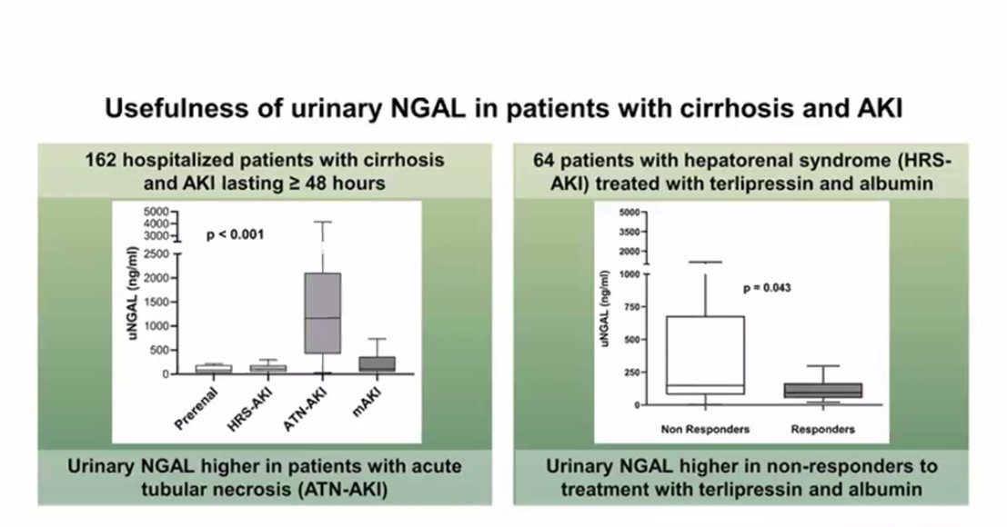 Women in Nephrology-India (@womenneph_india) on Twitter photo ❓How do biomarkers help in HRS-AKI? Urinary NGAL is higher in ATN-AKI and in non-responders to terlipressin . <a href="/SwarnalathaGud2/">Swarnalatha Guditi</a> <a href="/krithicism/">Krithika Mohan</a> <a href="/AnandhUrmila/">Urmila Anandh</a> ❓How do biomarkers help in HRS-AKI? Urinary NGAL is higher in ATN-AKI and in non-responders to terlipressin . <a href="/SwarnalathaGud2/">Swarnalatha Guditi</a> <a href="/krithicism/">Krithika Mohan</a> <a href="/AnandhUrmila/">Urmila Anandh</a>