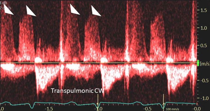 A patient with known heart failure. Transpulmonic CW Doppler is obtained. What is the cause of 'biphasic' pulmonic regurgitation as indicated by white arrowheads?