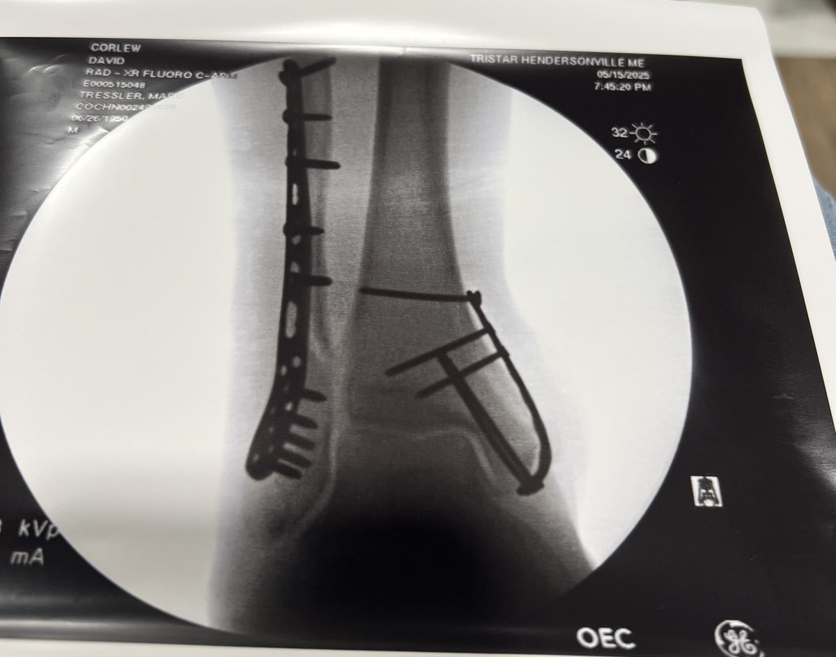 ATuffLife's tweet photo. kicked by bull during Spring works 2 weeks ago..
16 screws/ 3 plates/ 4 hours 
surgery…🙏🏼🎚👊🏽🇺🇸 https://t.co/gs1ntLnXx3