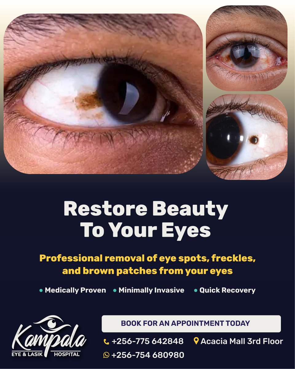 KampalaEyeLasik's tweet photo. Restore Natural Beauty to Your Eyes
Are you concerned about spots or discoloration on the white part of your eyes? These common conditions can affect your confidence and appearance.

• Eye spots and freckles that affect your appearance 
• Brown patches that have developed over time 
• Discoloration that may cause social discomfort

What causes eye spots and freckles?
• Prolonged sun exposure without UV protection
• Genetic factors that increase pigmentation
• Natural aging process of the eye
• Environmental irritants and dust exposure

Our advanced treatment methods:
✓ Laser therapy for precise spot removal 
✓ Specialized micro-surgical techniques 
✓ Topical medication for certain types of spots 
✓ Customized treatment plans for each patient

Why removal is important:
• Improves appearance and boosts confidence
• Prevents potential growth or spreading of spots
• Reduces eye irritation associated with some spots
• Allows for early detection of any concerning changes

Our procedures at Kampala Eye & Lasik Hospital are medically proven, minimally invasive, and offer quick recovery times. Don't let eye spots affect your confidence any longer.

Book an appointment today:
📞 +256-754 680980 | +256-775 642848 
📌 Acacia Mall, 3rd floor
👉 https://t.co/zvBqnMCA4O