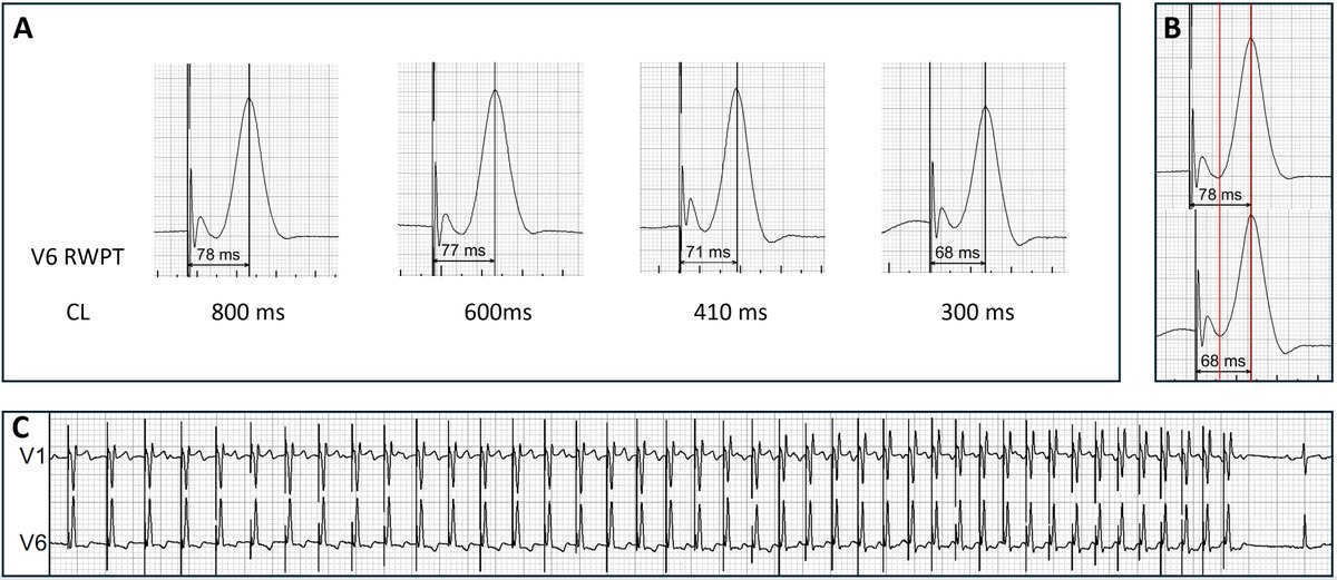 Marek Jastrzębski (@marek_jastrz_ep) on Twitter photo Do we understand V6RWPT during LBBAP? Look how many factors influence it: supernormality, rate, output amplitude. See authors.elsevier.com/a/1l8Hj5VtUyaJ… or doi: 10.1016/j.hrthm.2025.04.036
<a href="/Davilandre/">Andre d’Avila</a> #Epeeps <a href="/curilakarol/">curilakarol</a> <a href="/ZacharyWhinnett/">Zachary Whinnett</a> <a href="/Dr_JozaEP/">Jacqueline Joza</a> <a href="/OCanoPerez/">Óscar Cano</a> <a href="/MargaridaPujol/">Margarida Pujol Lopez</a> <a href="/kvernooy/">Kevin Vernooy</a> Do we understand V6RWPT during LBBAP? Look how many factors influence it: supernormality, rate, output amplitude. See authors.elsevier.com/a/1l8Hj5VtUyaJ… or doi: 10.1016/j.hrthm.2025.04.036
<a href="/Davilandre/">Andre d’Avila</a> #Epeeps <a href="/curilakarol/">curilakarol</a> <a href="/ZacharyWhinnett/">Zachary Whinnett</a> <a href="/Dr_JozaEP/">Jacqueline Joza</a> <a href="/OCanoPerez/">Óscar Cano</a> <a href="/MargaridaPujol/">Margarida Pujol Lopez</a> <a href="/kvernooy/">Kevin Vernooy</a>