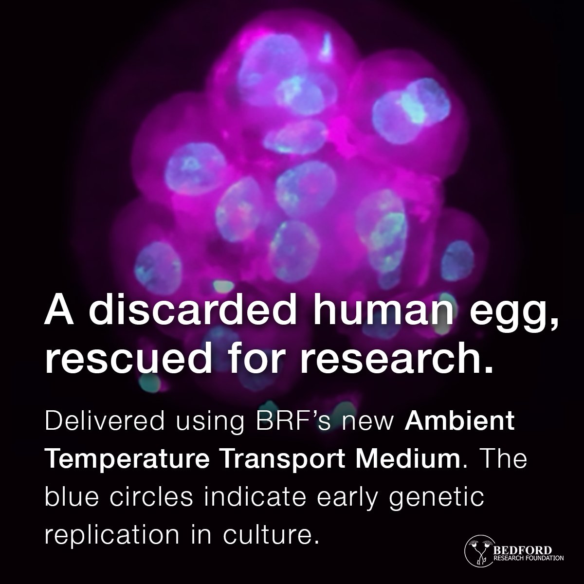 bedfordresearch's tweet photo. What happens to the eggs that don’t make the cut during fertility procedures? 

Most are discarded.

But now, some of them can be safely studied—thanks to a breakthrough in human egg transport.

https://t.co/Rrqs5lsIuE

#StemCellResearch #FertilityScience #BiotechInnovation https://t.co/qOF0KPFNlr