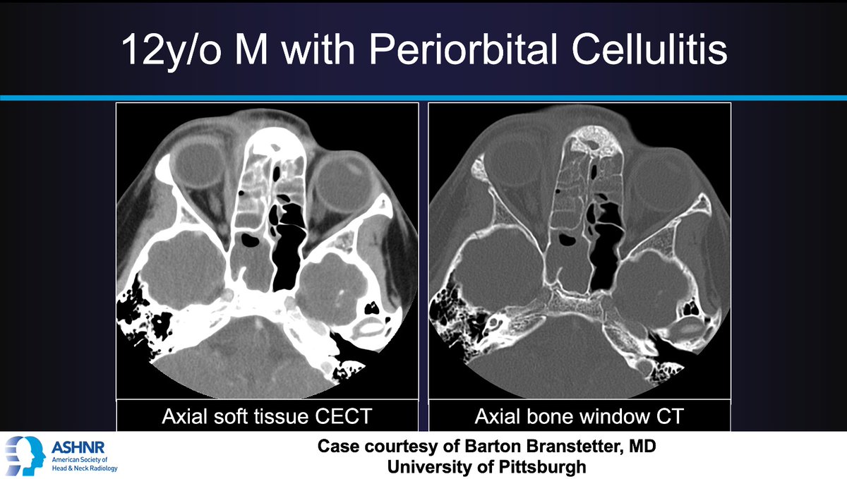 ASHNR (@ashnrsociety) on Twitter photo #ASHNRCOTW #298: Periorbital Infxn. Thx
<a href="/CharBranstetter/">Char Branstetter</a> 4 case! #ASHNR25
Answer w/ appropriate GIF only -- stay professional & don't spoil it!
<a href="/callyrobs/">Caroline Robson, MBChB</a> <a href="/DShatzkes/">Deborah Shatzkes</a> <a href="/CDP_Rad/">C Douglas Phillips 🇺🇸</a> <a href="/rhwiggins/">Richard Wiggins</a>
<a href="/nakoontz/">Nicholas Koontz</a> <a href="/KRileyMD/">Kalen Riley</a> <a href="/CMGlastonbury/">Christine M Glastonbury, MD</a> <a href="/tabby_kennedy/">Tabby A. Kennedy, MD</a> <a href="/PhilipRChapman1/">Philip R. Chapman, MD</a>
<a href="/cmtomblinson/">Courtney Tomblinson, MD</a> #ASHNRCOTW #298: Periorbital Infxn. Thx
<a href="/CharBranstetter/">Char Branstetter</a> 4 case! #ASHNR25
Answer w/ appropriate GIF only -- stay professional & don't spoil it!
<a href="/callyrobs/">Caroline Robson, MBChB</a> <a href="/DShatzkes/">Deborah Shatzkes</a> <a href="/CDP_Rad/">C Douglas Phillips 🇺🇸</a> <a href="/rhwiggins/">Richard Wiggins</a>
<a href="/nakoontz/">Nicholas Koontz</a> <a href="/KRileyMD/">Kalen Riley</a> <a href="/CMGlastonbury/">Christine M Glastonbury, MD</a> <a href="/tabby_kennedy/">Tabby A. Kennedy, MD</a> <a href="/PhilipRChapman1/">Philip R. Chapman, MD</a>
<a href="/cmtomblinson/">Courtney Tomblinson, MD</a>