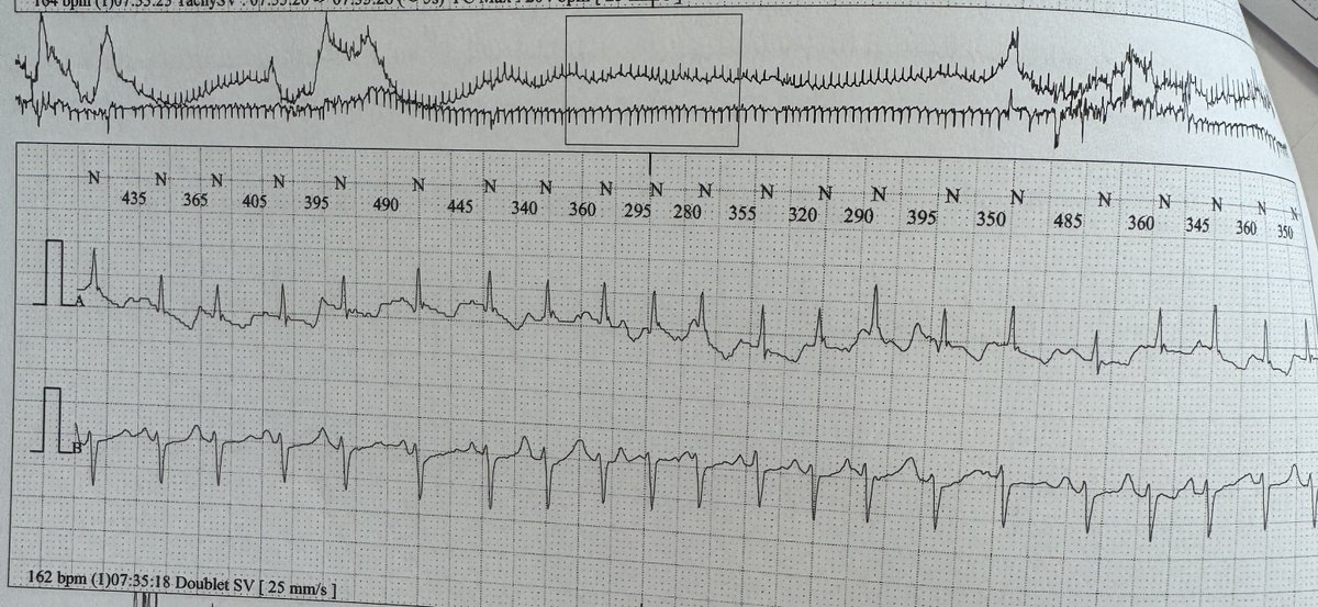 DairiMouloud's tweet photo. 88 yo woman with presyncope/syncope
Rythme? 
Holter strip

@anais_dahoumane 
@ecgandrhythmRoe https://t.co/DZO6aXAKiv