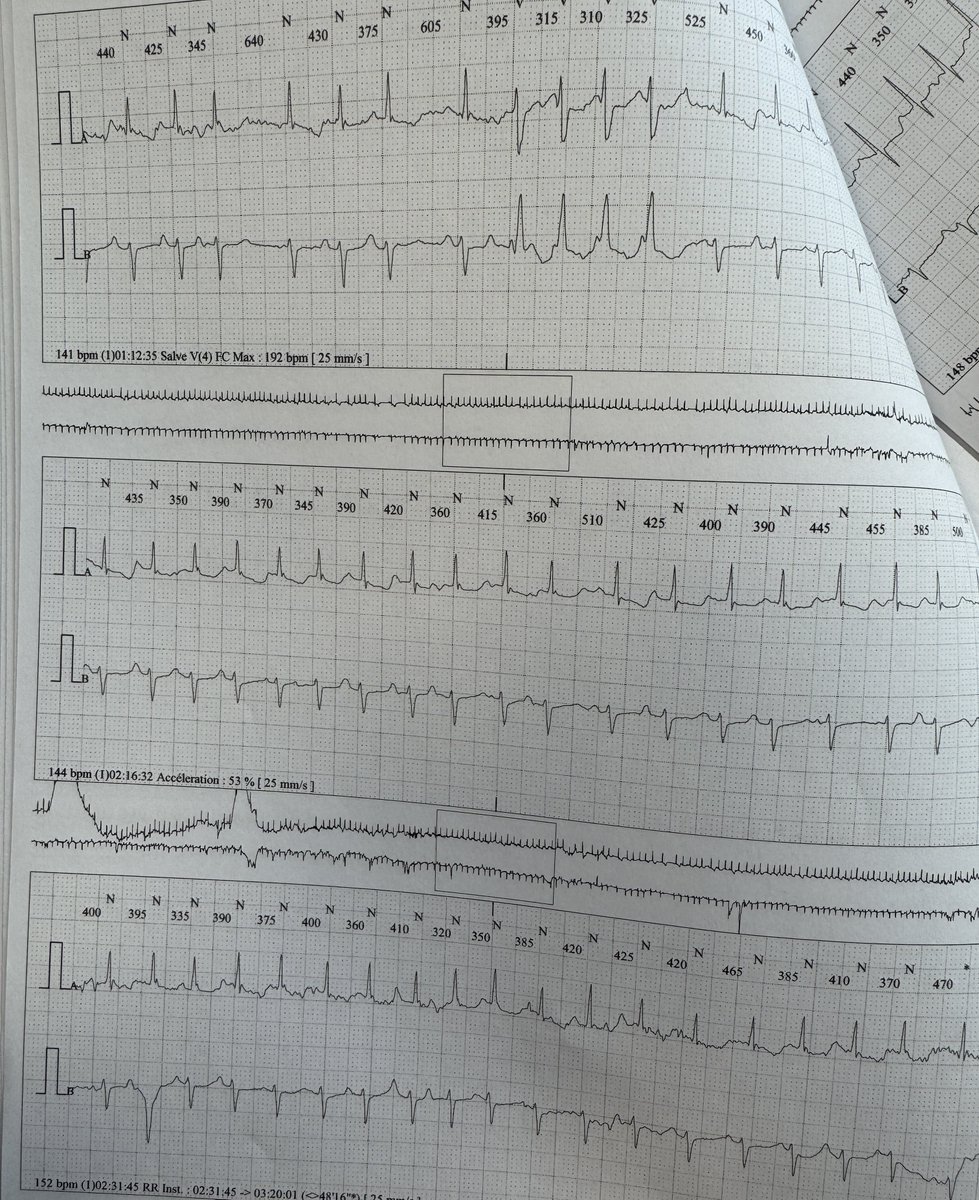 DairiMouloud's tweet photo. 88 yo woman with presyncope/syncope
Rythme? 
Holter strip

@anais_dahoumane 
@ecgandrhythmRoe https://t.co/DZO6aXAKiv