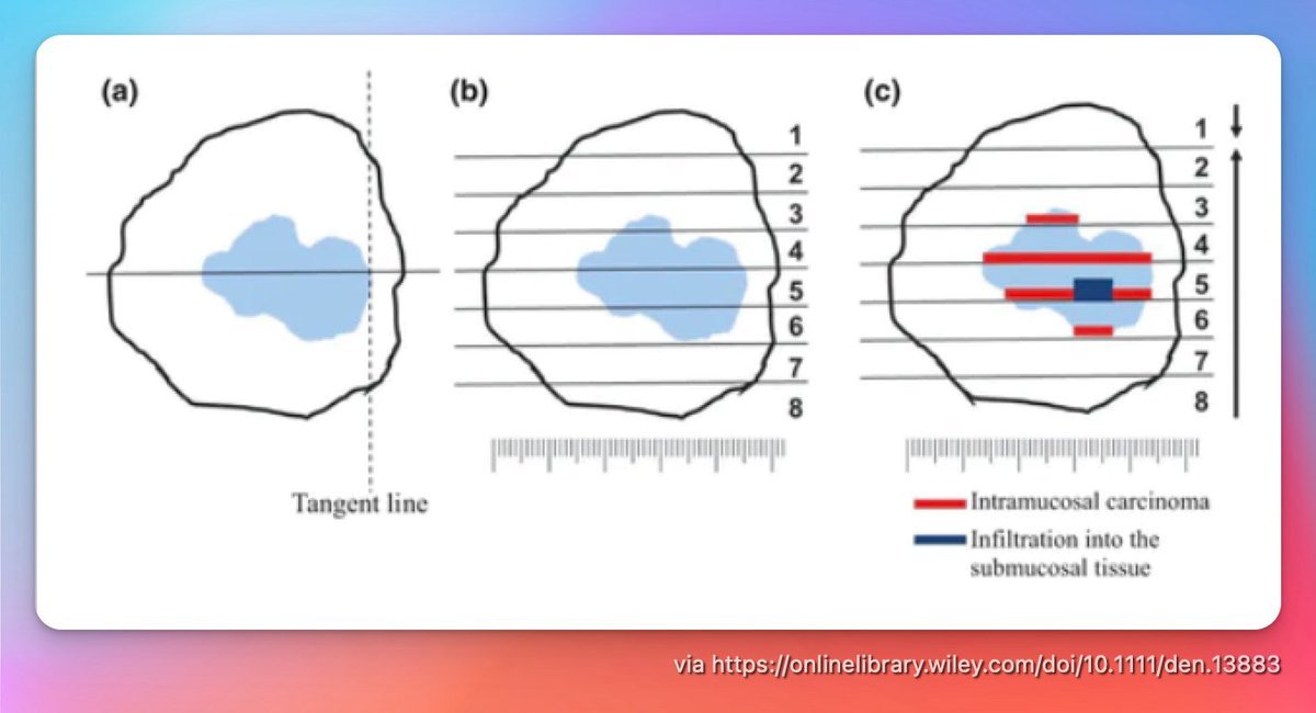 EndoCollabcom's tweet photo. Guidelines for ESD &amp; EMR in Early Gastric Cancer

Precise assessment of tumor depth is critical. Use the tangent line method to evaluate intramucosal carcinoma (red) and submucosal infiltration (blue) for optimal resection outcomes. https://t.co/u7pDJDtIwJ