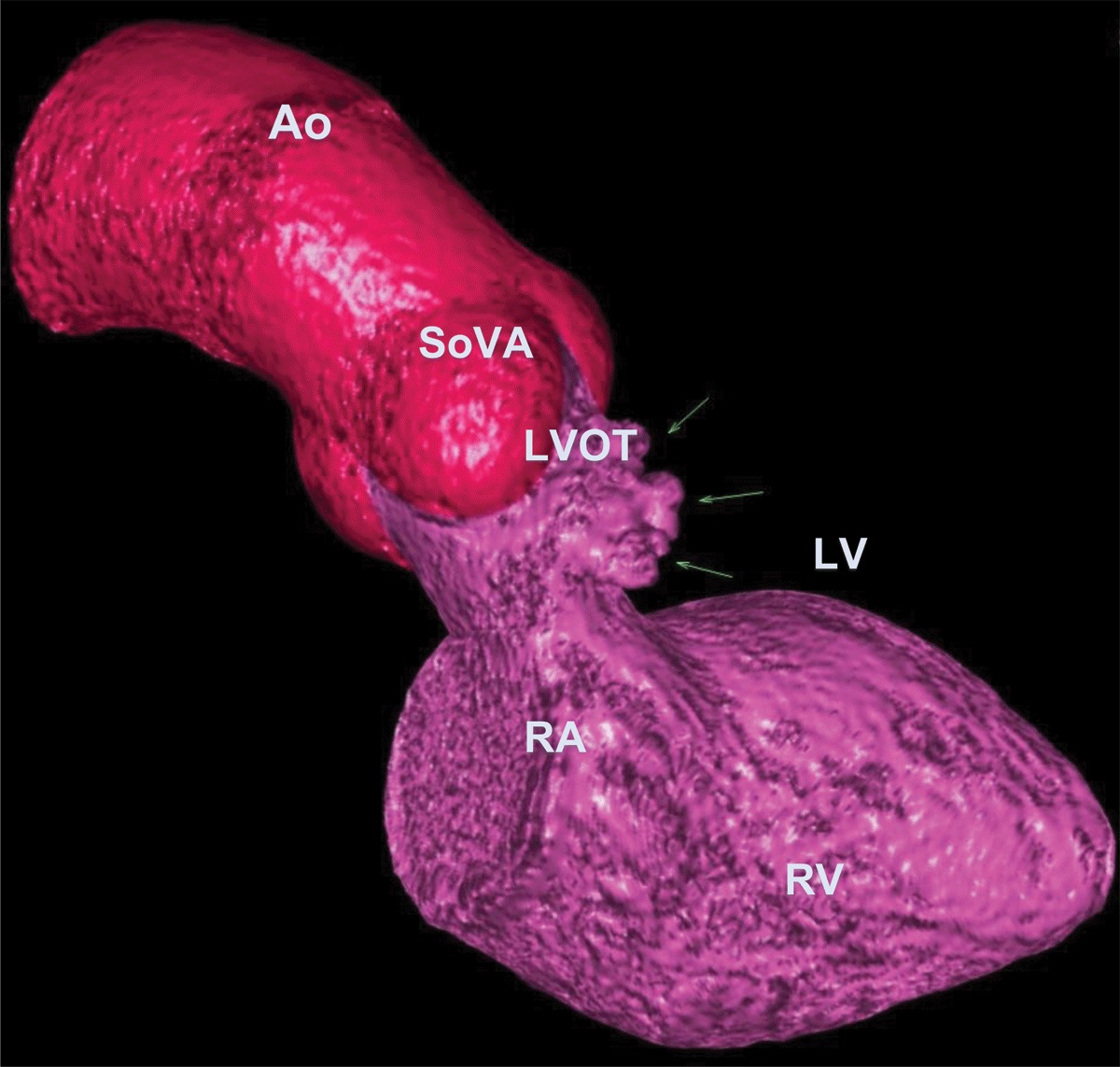 DeBakey CV Education - World Class CV Training (@debakeycvedu) on Twitter photo New #DeBakeyCVJournal MMI!
"Uncovering a Windsock Aneurysm of the Interventricular Septum: An Incidental Structural Abnormality" by <a href="/mderdem3/">Saliha Erdem MD</a> & Kazim Baser #HMHfellows <a href="/HMHCardioFellow/">Houston Methodist Cardiovascular Fellowships</a>
Images & more doi.org/10.14797/mdcvj…
<a href="/maquinonesmd/">M Quinones MD, MACC</a> <a href="/NadeenFaza/">Nadeen N. Faza, M.D.</a> <a href="/CardioNerds/">CardioNerds</a> #MedEd New #DeBakeyCVJournal MMI!
"Uncovering a Windsock Aneurysm of the Interventricular Septum: An Incidental Structural Abnormality" by <a href="/mderdem3/">Saliha Erdem MD</a> & Kazim Baser #HMHfellows <a href="/HMHCardioFellow/">Houston Methodist Cardiovascular Fellowships</a>
Images & more doi.org/10.14797/mdcvj…
<a href="/maquinonesmd/">M Quinones MD, MACC</a> <a href="/NadeenFaza/">Nadeen N. Faza, M.D.</a> <a href="/CardioNerds/">CardioNerds</a> #MedEd