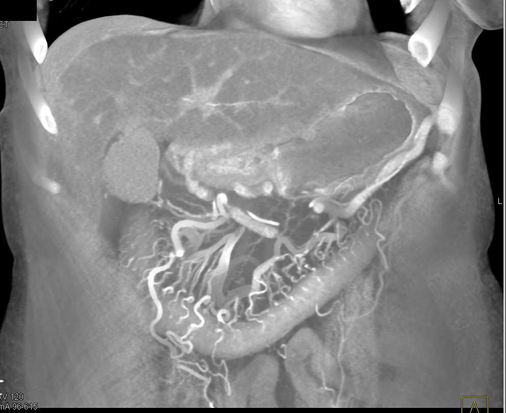 Pancreatic Cancer with Vessel Encasement and Involvement of the Transverse Colon seen: ctisus.com/teachingfiles/…