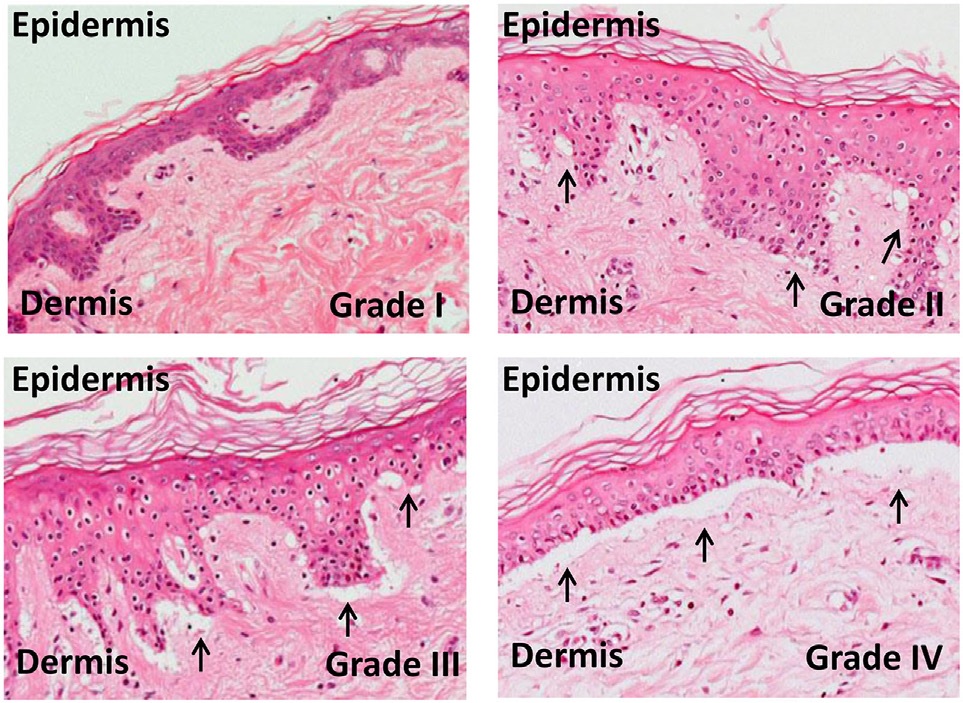 Signals (@signalsblogs) on Twitter photo Mesenchymal stromal cells (MSCs) can now be used in routine clinical practice thanks to a historic decision by the <a href="/US_FDA/">U.S. FDA</a> to approve <a href="/Mesoblast/">Mesoblast News</a>'s #Ryoncil for pediatric patients with #GVHD. <a href="/KP_Robb/">Kevin Robb, PhD</a> breaks it down here: signalsblog.ca/mesenchymal-st… Mesenchymal stromal cells (MSCs) can now be used in routine clinical practice thanks to a historic decision by the <a href="/US_FDA/">U.S. FDA</a> to approve <a href="/Mesoblast/">Mesoblast News</a>'s #Ryoncil for pediatric patients with #GVHD. <a href="/KP_Robb/">Kevin Robb, PhD</a> breaks it down here: signalsblog.ca/mesenchymal-st…