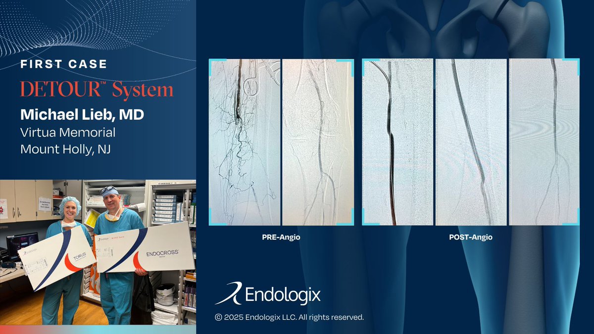 Congrats Michael Lieb, MD, on your first #PTAB case with the #DETOURSystem, and being the first PTAB completed overall at Virtua Memorial in Mount Holly, NJ. A 72 year-old male presented with known CTO of the left #SFA with reconstituted popliteal and preserved outflow in calf.