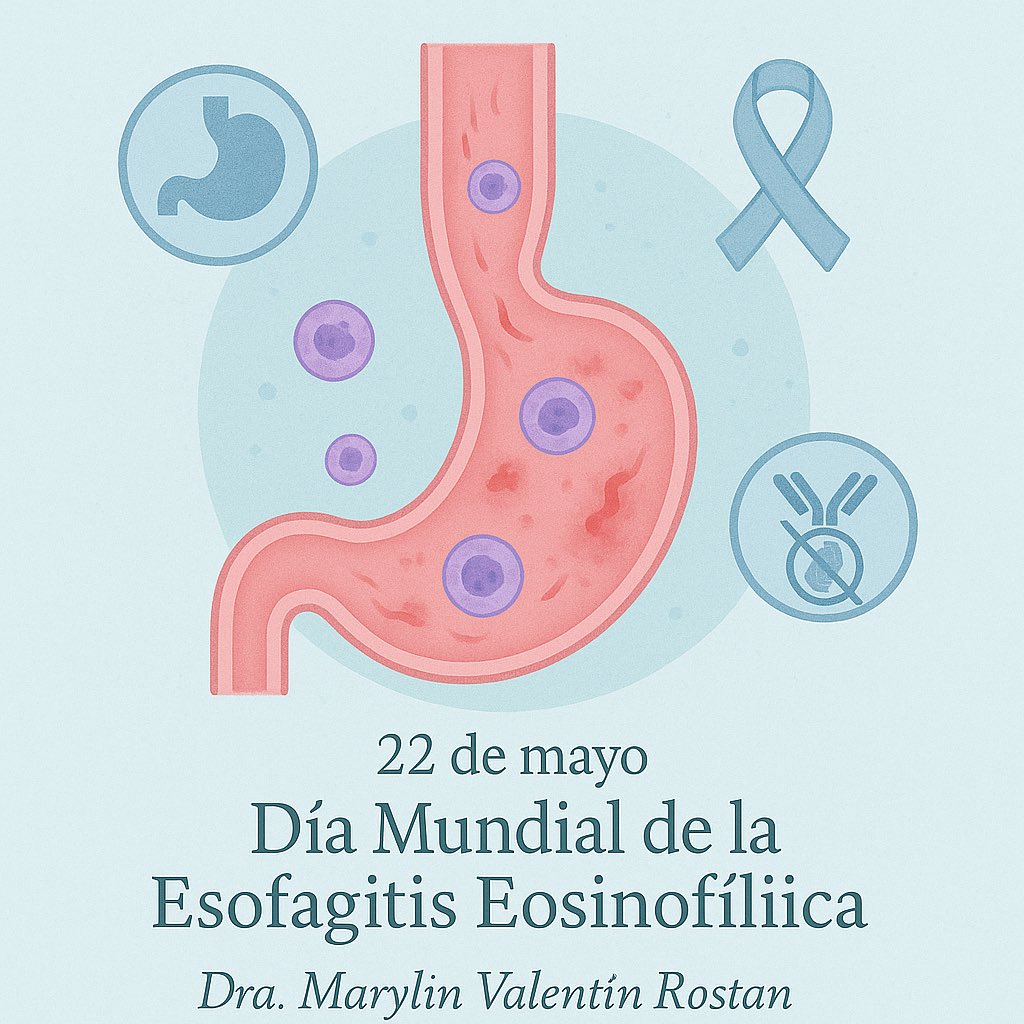 #DiaMundialDeLaEsofagitisEosinofilica: Hoy 22 de Mayo
🧬 ¿Qué es la Esofagitis Eosinofílica?

La EoE es una enfermedad inflamatoria crónica del esófago, caracterizada por la acumulación de eosinófilos, un tipo de glóbulos blancos, en el revestimiento esofágico. Esta acumulación