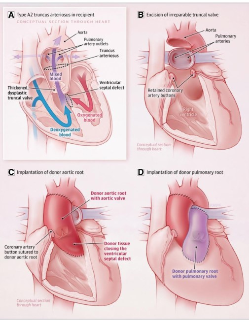 Circulation (@circaha) on Twitter photo Partial Heart Transplantation: a comprehensive review of partial heart transplantation, including current status, clinical adaptation, and future directions.<a href="/Neel_Prabhu/">Neel Prabhu</a> <a href="/TurekPedHearts/">Joseph W Turek</a>
<a href="/justlikemike45/">Michael Mensah-Mamfo</a> ahajournals.org/doi/full/10.11… Partial Heart Transplantation: a comprehensive review of partial heart transplantation, including current status, clinical adaptation, and future directions.<a href="/Neel_Prabhu/">Neel Prabhu</a> <a href="/TurekPedHearts/">Joseph W Turek</a>
<a href="/justlikemike45/">Michael Mensah-Mamfo</a> ahajournals.org/doi/full/10.11…